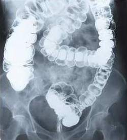 Barium Enema X-Ray