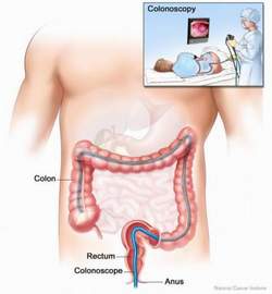 Colonoscopy