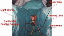 Cystoscopy