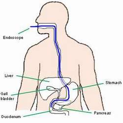 ERCP
