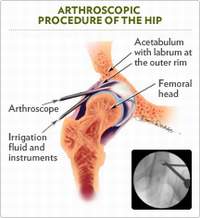 Hip Arthroscopic