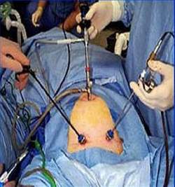 Laparoscopy