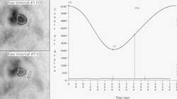 MUGA Scan