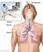 Mesothelioma Treatment