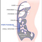 Peritoneal Mesothelioma Cancer