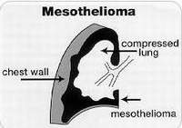 Pleural Effusion