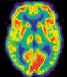 Positron Emission Tomography
