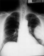 mesothelioma
